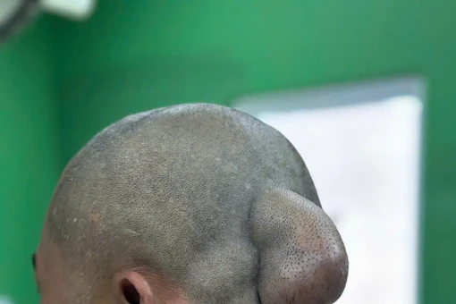 Bệnh viện Đại học Y Dược-Hoàng Anh Gia Lai cắt bỏ thành công khối u lạ 30 năm treo trên đầu bệnh nhân