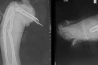 Tay áo khoác cuốn vào bánh xe, bé gái bị kéo đứt lìa cánh tay