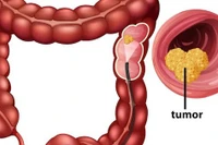 Loại quả ngon ngọt được phát hiện có khả năng ngăn chặn ung thư đại trực tràng