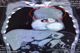 Phẫu thuật thành công khối u kích thước bằng quả cam trong lồng ngực