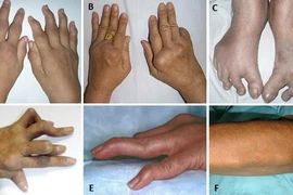 Cách nhận biết sớm bệnh viêm khớp dạng thấp