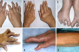 Cách nhận biết sớm bệnh viêm khớp dạng thấp