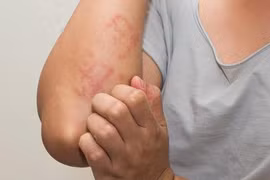 Những biểu hiện 'tố' bạn bị dị ứng thuốc