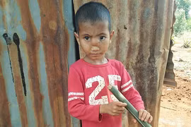 Bé trai 5 tuổi bị thoát vị não xuống mũi