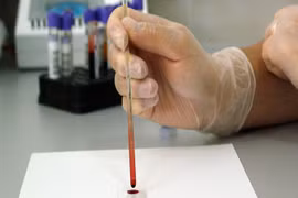 Phát minh thiết bị phát hiện vi khuẩn chỉ trong ít phút