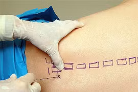 Sản phụ tử vong sau khi sinh con bằng phương pháp gây tê tủy sống