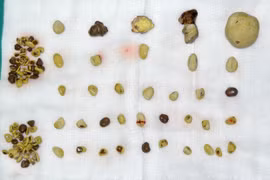 Lấy thành công hơn 100 viên sỏi từ thận của nam bệnh nhân