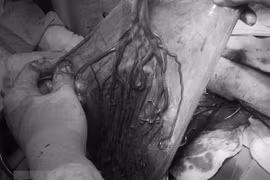 Cần Thơ: Cứu sống thai nhi bị dây rốn bám màng hiếm gặp