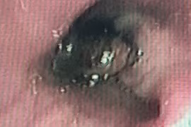 Nam bệnh nhân suýt chết vì hạt vú sữa nằm 1 tháng trong phế quản