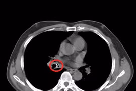 Gắp thành công mẫu xương gà mắc trong lòng phế quản gần 1 tháng