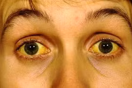 Những biểu hiện không ngờ của ung thư tụy dễ dàng bị bỏ qua