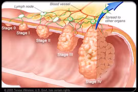 Những dấu hiệu báo động ung thư đại tràng đã di căn
