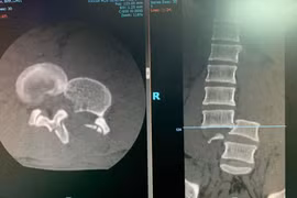 Mổ thành công bệnh nhân gãy cột sống