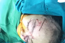 Bé 31 tháng tuổi bị chó cắn rách nát vùng mặt