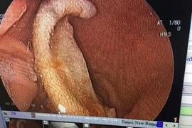 Nội soi lấy phần tai bị cắn đứt trong bụng một học sinh