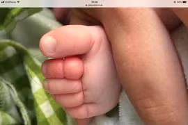 Bé sơ sinh suýt mất 4 ngón chân chỉ vì một sợi tóc của mẹ