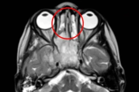 Tưởng viêm xoang, sổ mũi, hóa ra… ung thư