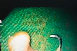 Răng giả "mất tích" trong thực quản