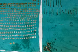 Nuốt 7 kg kim loại vào bụng