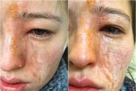 Bất cẩn khi dùng máy xông hơi tinh dầu, cô gái Mỹ bỏng nặng