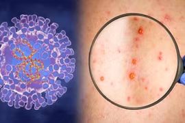 Giám sát cửa khẩu, cơ sở khám chữa bệnh và sự kiện đông người để phát hiện sớm bệnh đậu mùa khỉ