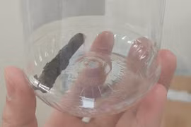 Chàng trai 14 năm "sống chung" với nhánh cây trong phổi