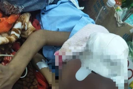 Đắp thuốc trôi nổi,mụn nhỏ thành khối u ác tính che kín mặt bé trai