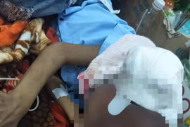 Đắp thuốc trôi nổi,mụn nhỏ thành khối u ác tính che kín mặt bé trai