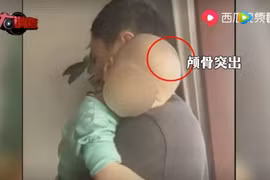 Trung Quốc: Xuất hiện loại "sữa bột" trẻ em uống vào bị bệnh "đầu to mình nhỏ"