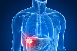 2 loại thuốc "cũ" bất ngờ cứu người ung thư gan ngoạn mục