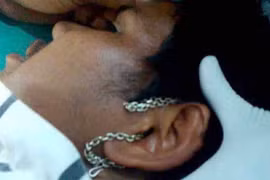 Sợi dây chuyền mắc kẹt hi hữu trong lỗ tai nam thanh niên