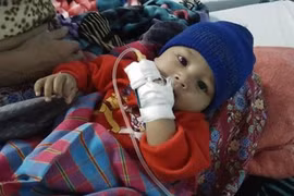 Bé 5 tháng tiểu ra máu, thận đầy sỏi do mẹ cai sữa sớm