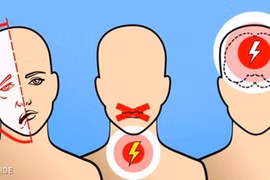 6 dấu hiệu cảnh báo cơn đột quỵ não