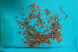 Hi hữu bác sĩ gắp từ túi mật nữ bệnh nhân gần 400 viên sỏi