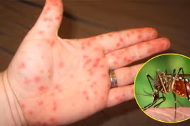 Báo động đỏ dịch sốt xuất huyết tại TP. Hồ Chí Minh