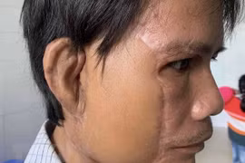 Thực hiện thành công nuôi cấy tai người dưới cẳng tay và cấy ghép lại