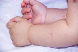 Bệnh tay chân miệng dễ nhầm lẫn với sốt mọc răng và bệnh khác