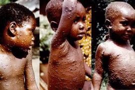 WHO dự báo dịch bệnh đậu mùa khỉ sẽ tiếp tục gia tăng