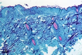 Mexico ghi nhận ca bệnh đậu mùa khỉ đầu tiên, có thể từ Hà Lan