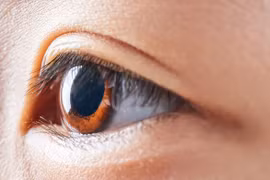 Kính áp tròng làm chậm tiến triển cận thị