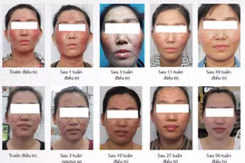 Làm trắng da siêu tốc với mỹ phẩm 'nhà làm', ai ngờ dính 'độc dược'