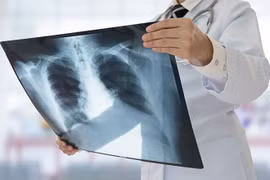 10 triệu chứng khác thường của bệnh ung thư phổi