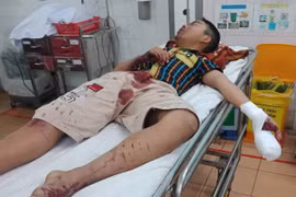 Một thiếu niên bị thương nặng do đốt pháo
