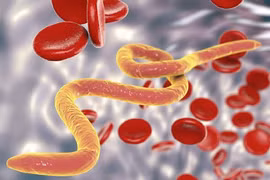 Cụ ông bị vôi hóa tinh hoàn nghiêm trọng do ký sinh trùng