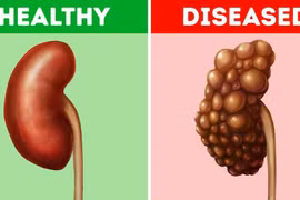 Những thói quen này có thể hại thận của bạn