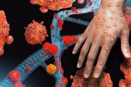 Bộ Y tế bổ sung đậu mùa khỉ vào danh mục bệnh truyền nhiễm nhóm B