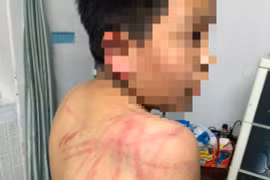 Khởi tố, bắt giam kẻ bạo hành con ruột dã man ở Đà Lạt