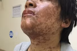 Tự uống thuốc cảm, cô gái nổi mẩn toàn thân