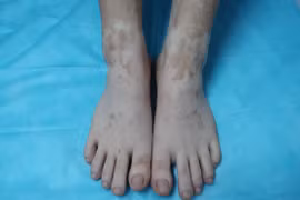 Sự nguy hiểm của lá trầu không ít người biết