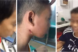 Nghệ An phát hiện 3 trẻ em mắc bệnh Whitmore